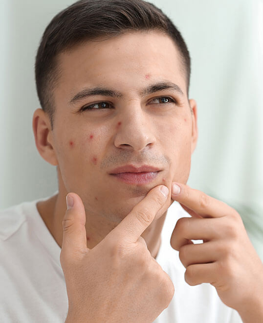 Man with acne in need of AviClear acne treatment from Beauty & Health by Liz