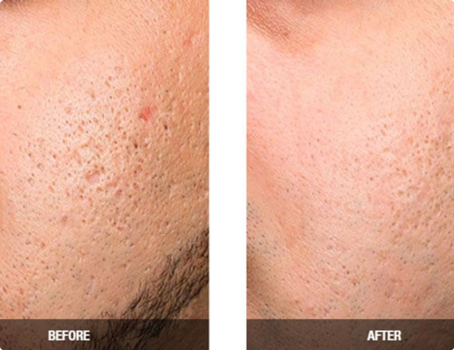 Exceed Microneedling in Tucson before and after treatment at Beauty & Health by Liz