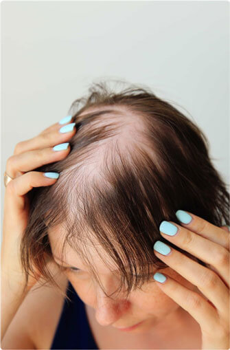 Woman falling out hair in need of hair restoration by Beauty & Health by Liz in Tucson, AZ