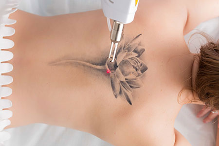 tattoo removal large size tattoo<br />
