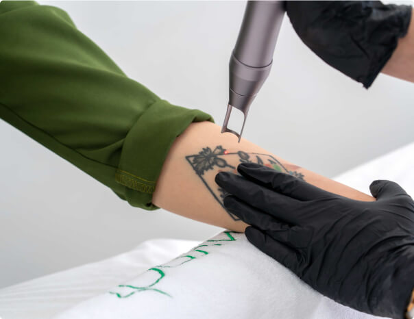patient undergoing tattoo removal in Tucson, AZ at Beauty & Health by Liz<br />
