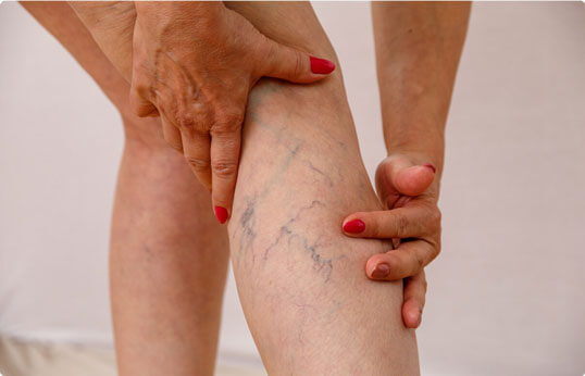 Legs showing spider vein in Tucson at Beauty & Health by Liz