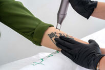 Tattoo Removal in Tucson, AZ  at Beauty & Health by Liz
