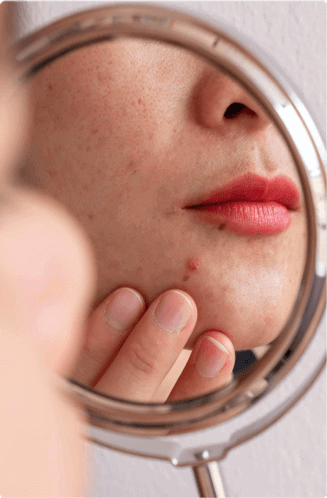 AviClear acne treatment in Beauty & Health by Liz