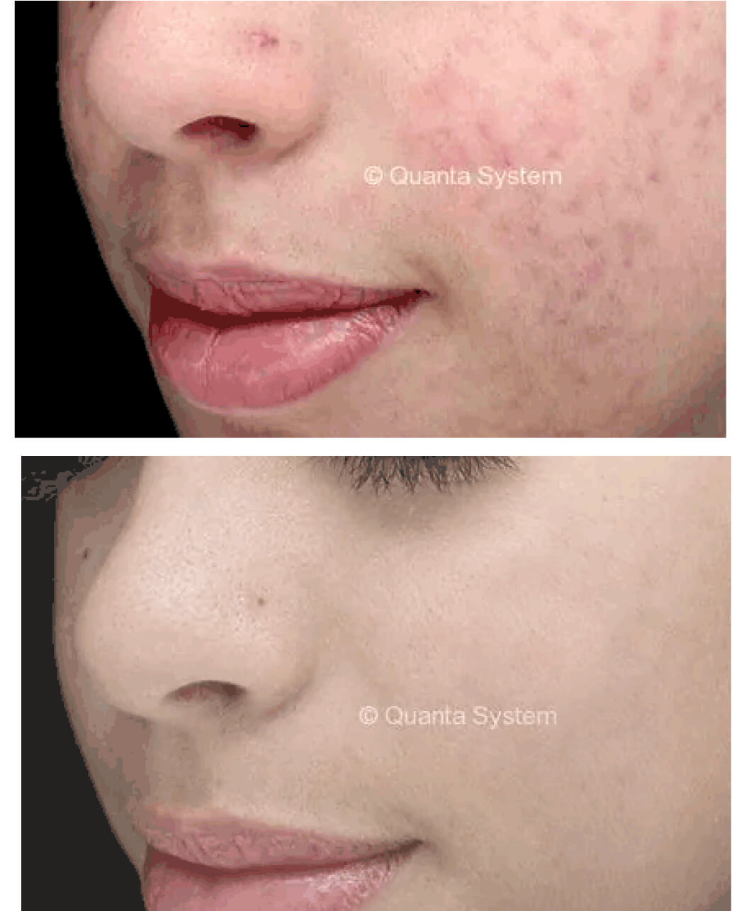laser scar removal before and after